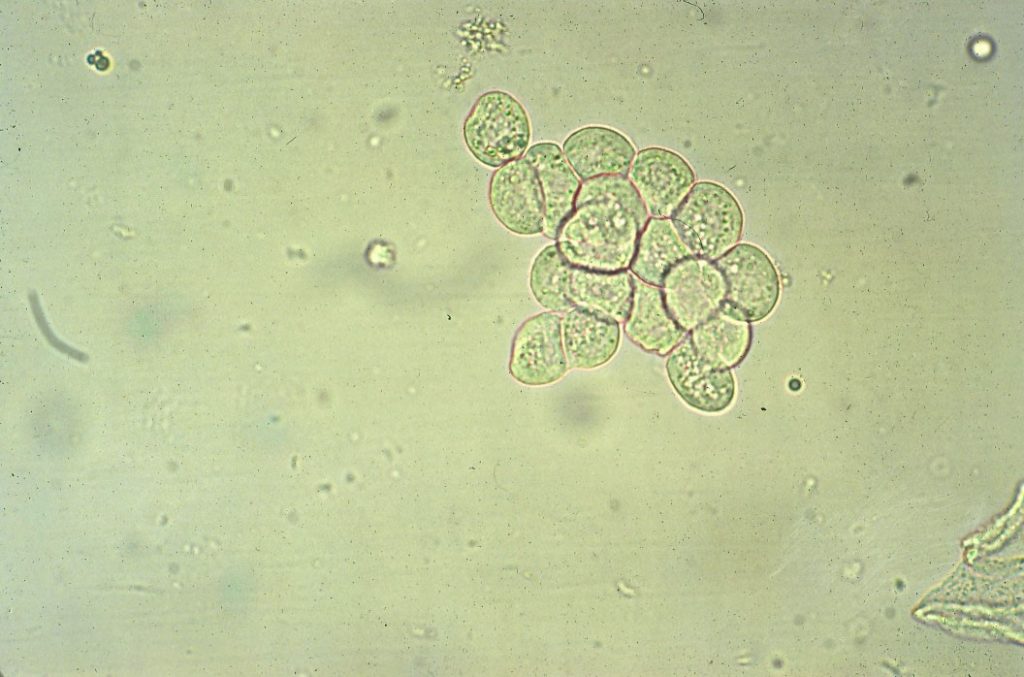 Module 8.4: Common Structures Observed on the Sediment Exam – Clinical ...