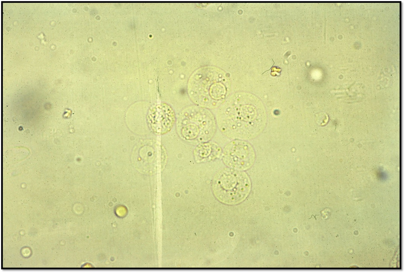 Clusters of round (transitional) cell epithelium