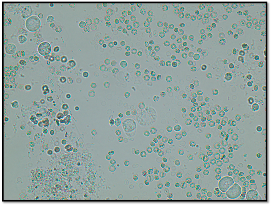 An example at 40x objective of several round cells with many RBC’s and WBC's in the background for size comparison.