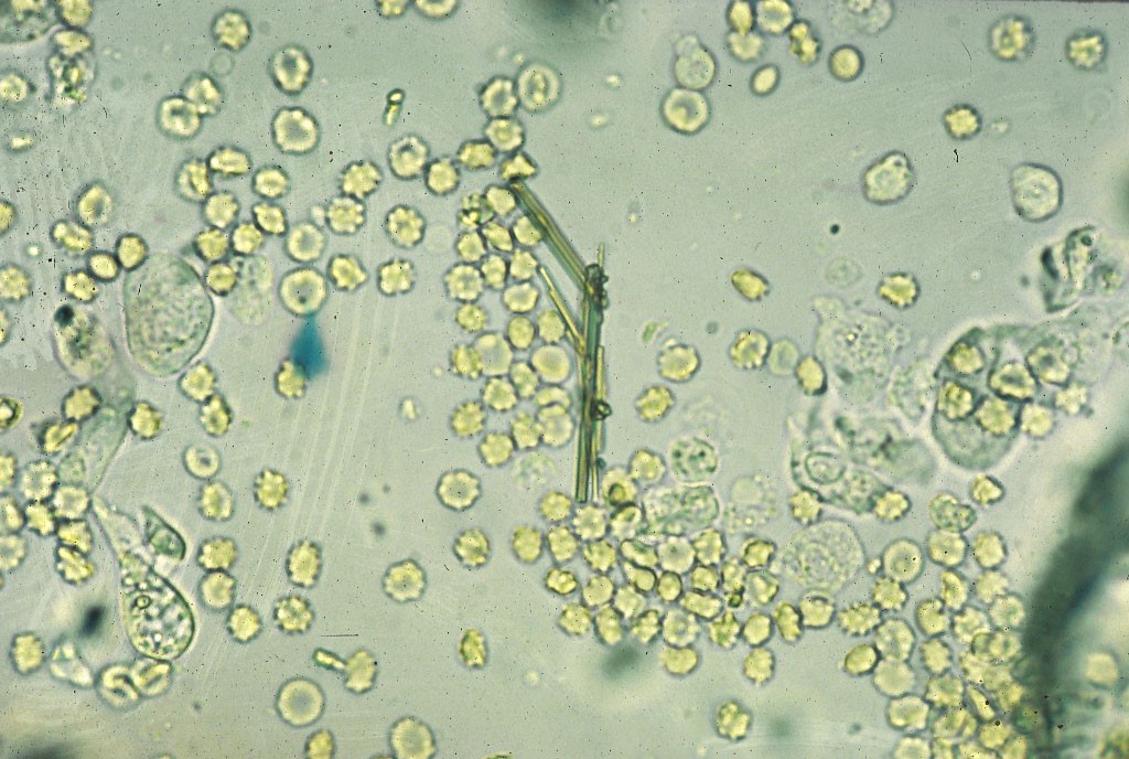 Many RBCs mixed with squamous epithelial cells. In the center of the photo are linear crystals that have precipitated off of the dipstick pad. 40x objective