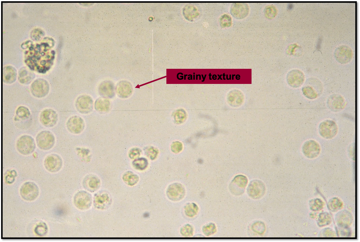 40x magnification of WBCs in urine. There are also low numbers of RBCs in this image
