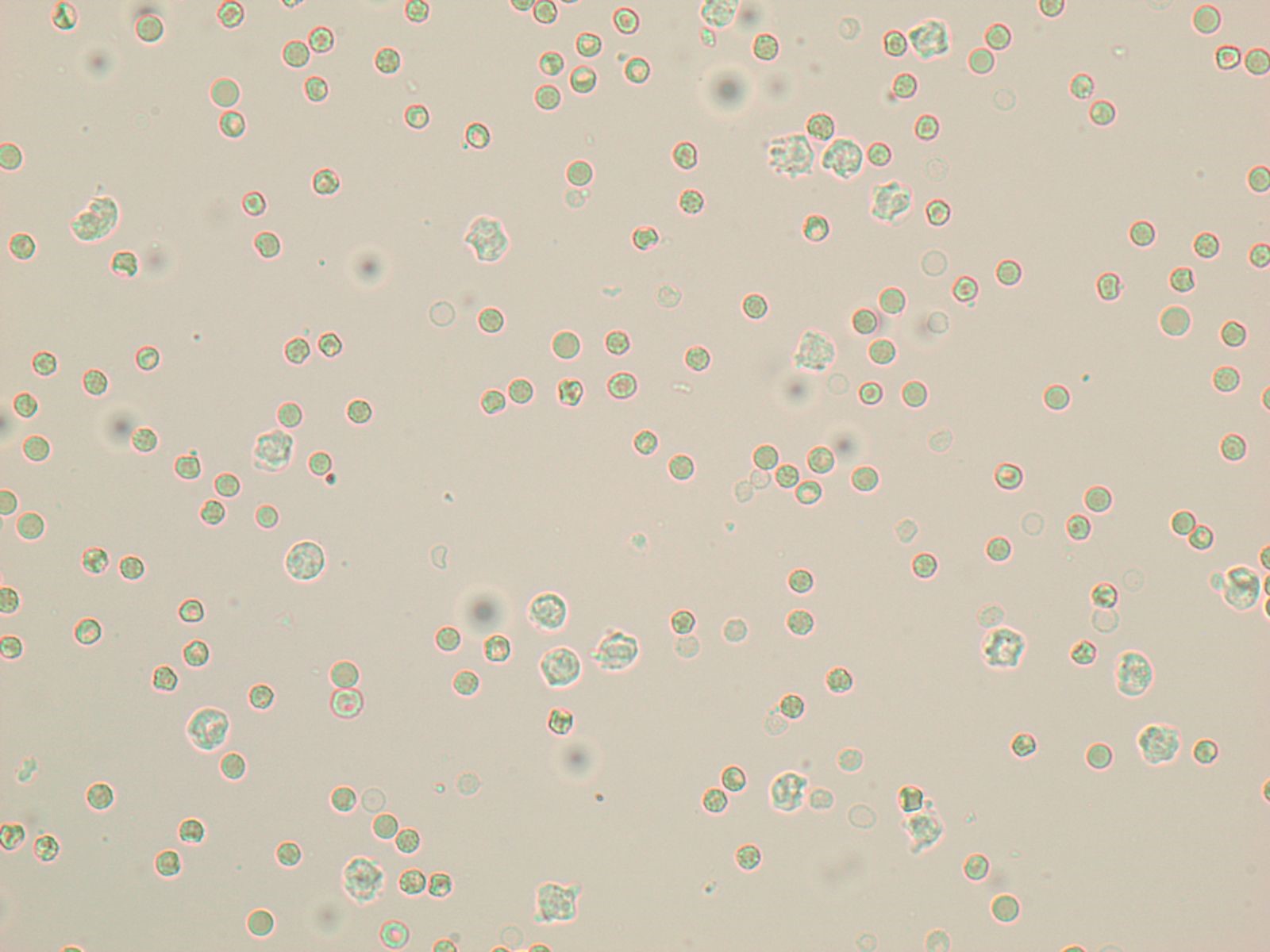 40x objective of pyuria and hematuria. In this image the RBCs appear deeper yellow (from Hb) and smaller than the lighter in color and grainy WBCs.