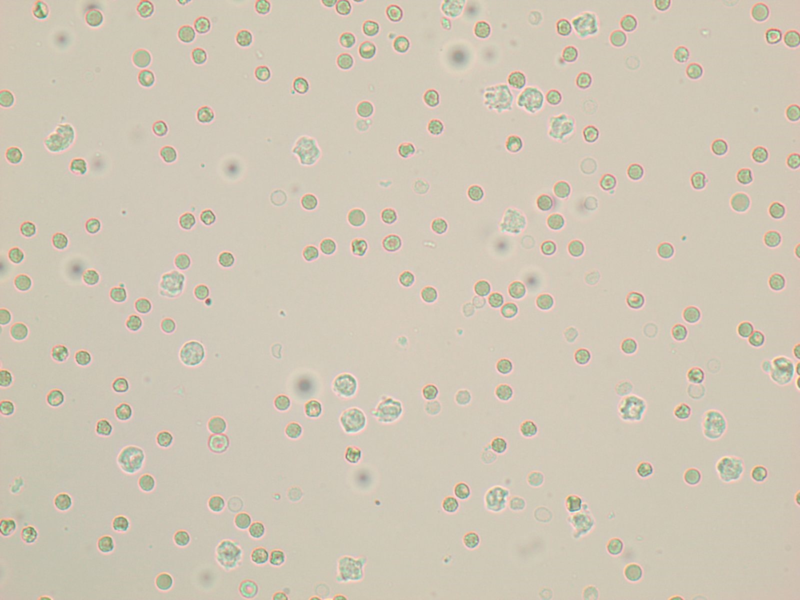 Red Blood Cells And White Blood Cells In Urine