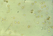 Module 8.4: Common Structures Observed on the Sediment Exam – Clinical ...