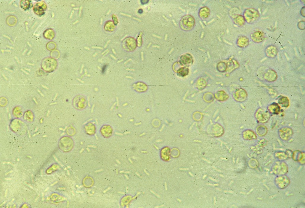 Urine Sediment Rbc And Wbc