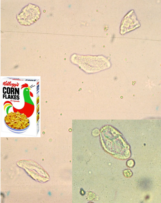 Several squamous epithelial cells at 10x and 40x (inset) magnification. These cells have not been stained. In the inset, you can also visualize 2 RBCs (smooth round structures directly adjacent to squamous epithelial cell) and 2 WBCs that are more irregular in shape and grainy appearance