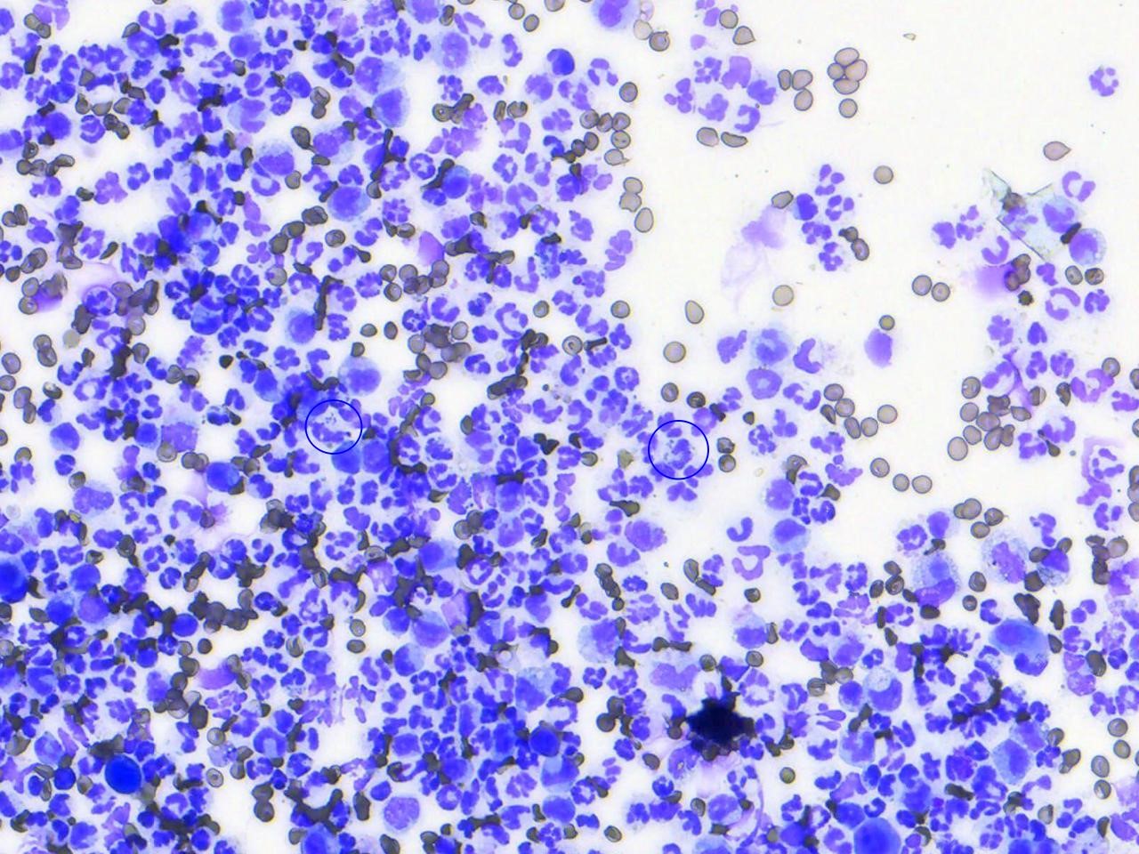 Fine-needle aspirates from an abscess in a dog. In this image, you can see that there is marked suppurative inflammation characterized by many degenerate neutrophils and low numbers of macrophages. Degenerate neutrophils containing phagocytized bacteria are circled. 100x objective
