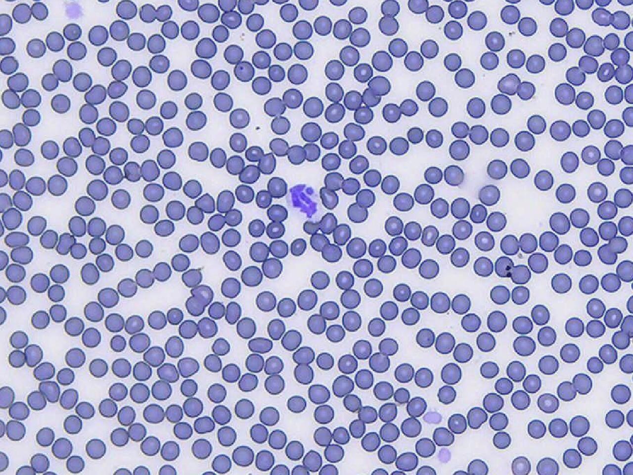 Canine blood smear with a single segmented neutrophil that contains a single Anaplasma phagocytophilum morula. Tee morula is the blue, circular structure on the northern end of the cell. You can appreciate that the bacteria in the abscess and the bacterial morulae in this smear are the same blue color. 100x objective