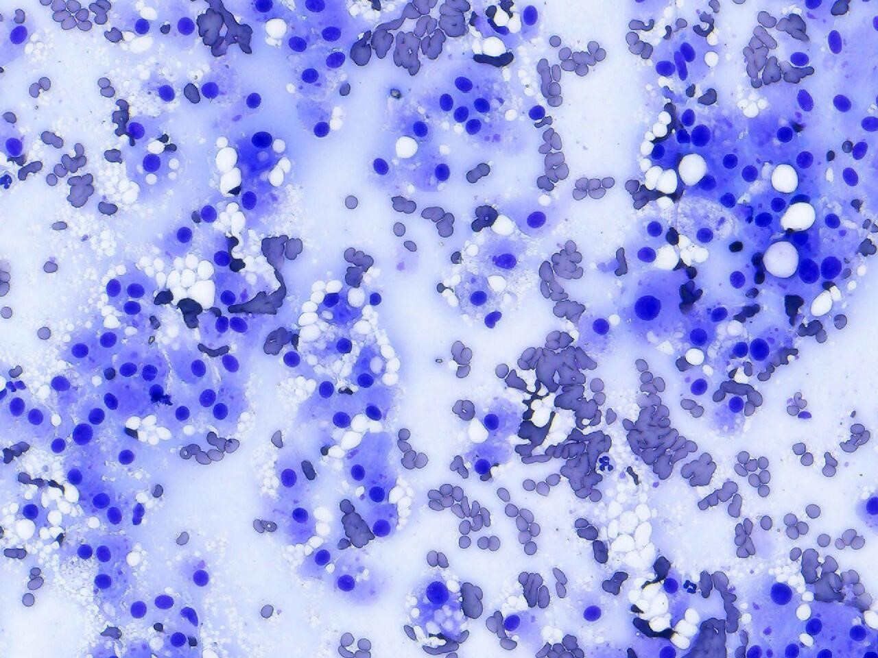 Liver aspirates from a dog with well-differentiated hepatocellular carcinoma. You can see that the neoplastic hepatocyte nuclei are round, 2x the diameter of an RBC and placed in the center of the cells. The cytoplasm is the pale blue color that surrounds the nuclei. Sometimes the cytoplasm has variably sized lipid droplets within the cytoplasm. 50x objective
