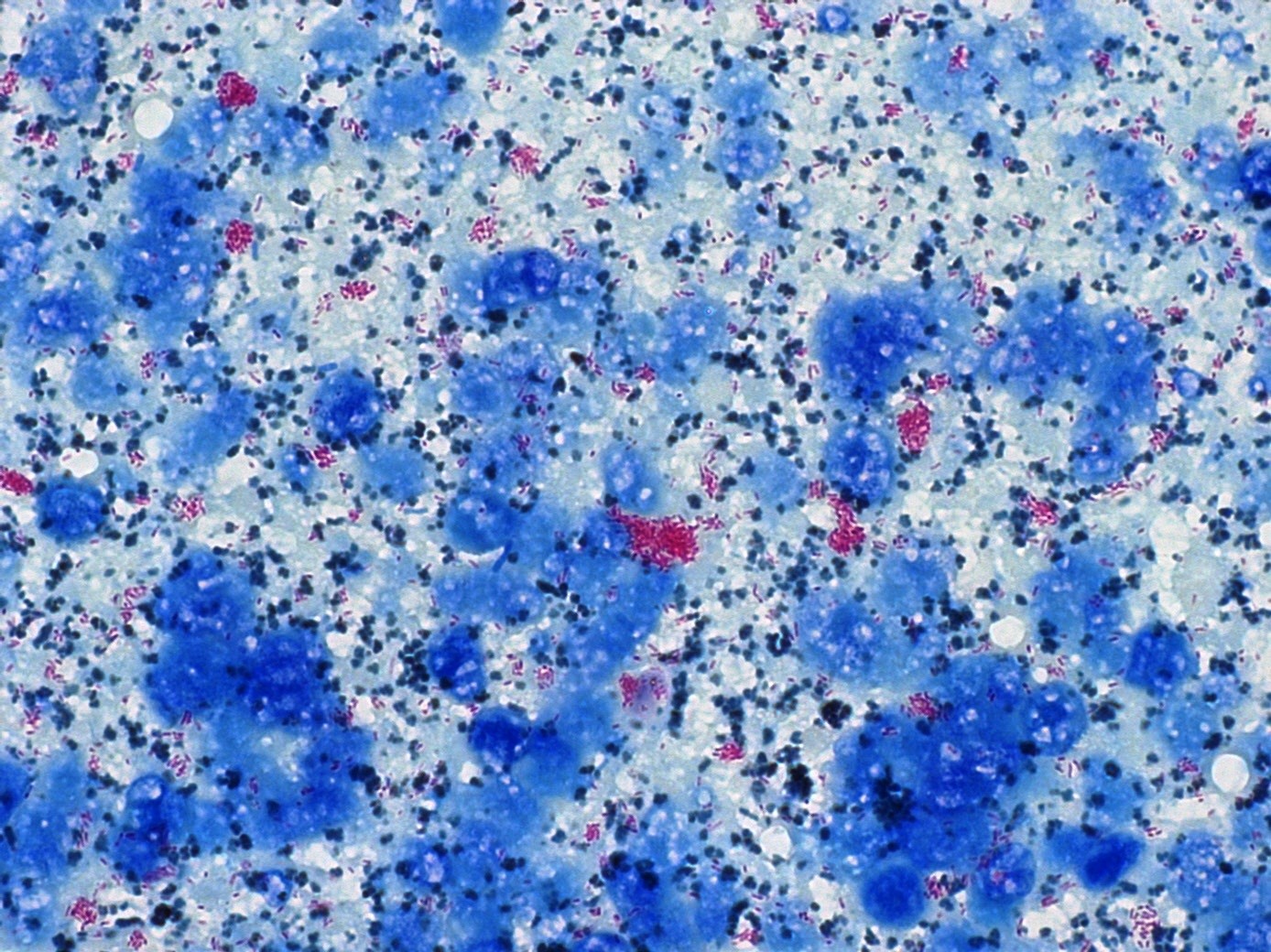 In the image above from a fine needle aspirate of a skin lesion, you see a tremendous amount of cellular debris that is picking up the methylene blue counterstain. Amongst the cellular debris are many individualized and aggregates of rod-shaped, acid-fast bacteria that appear bright