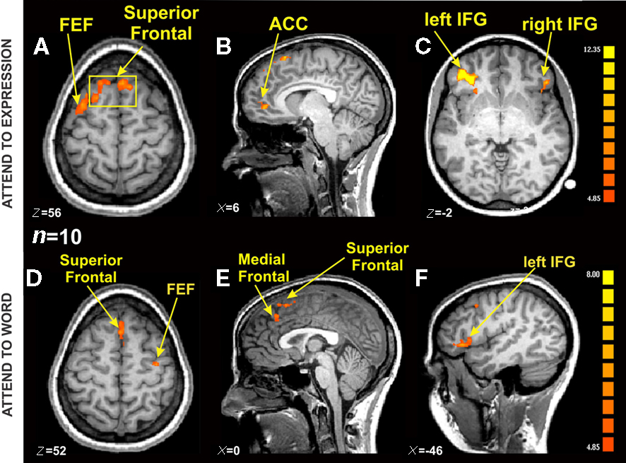 Image showing different angles of an fMRI scan with various sections highlighted to demonstrate blood flow.