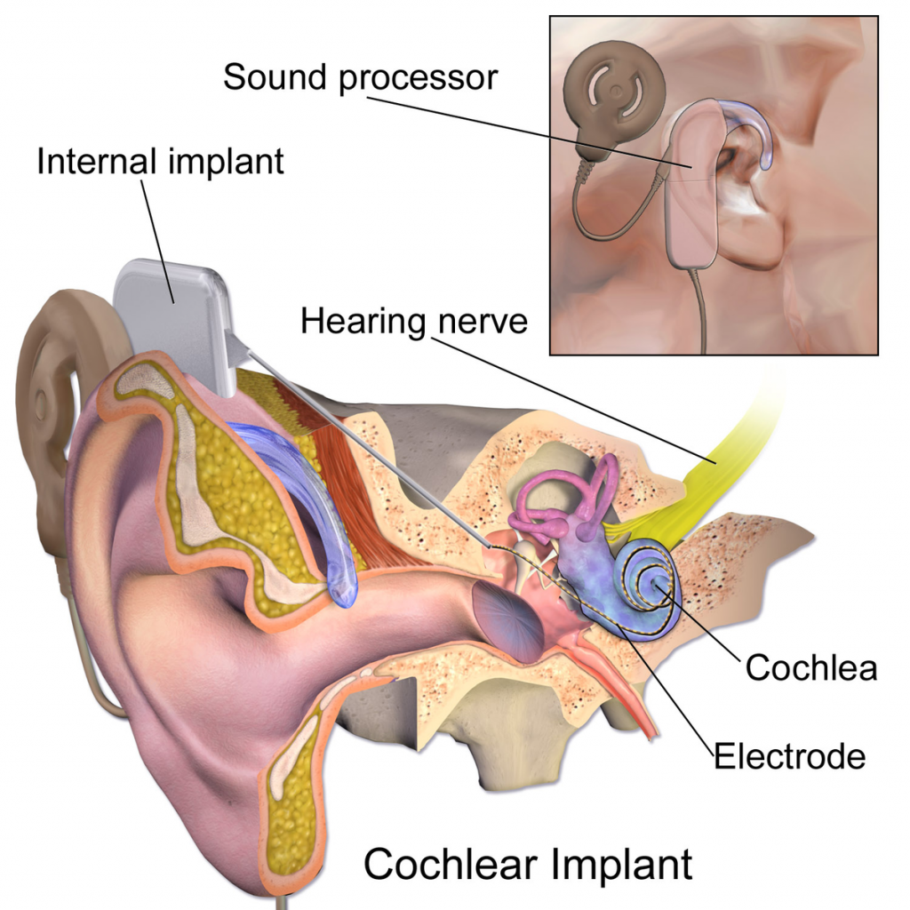 A cochlear implant is shown within the cartoon anatomy of the ear. They have an external view as well as an internal view with the path the electrodes take in the ear.