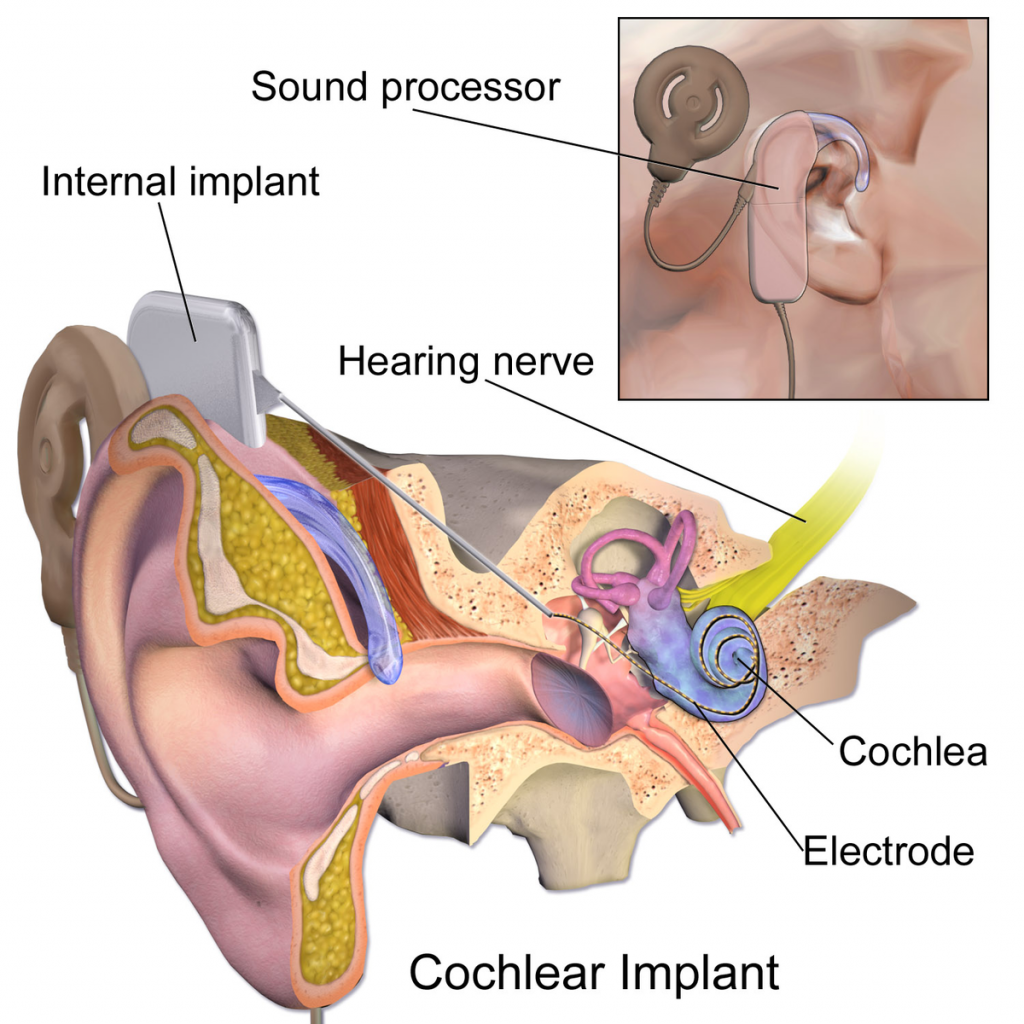 Cochlear Implants Introduction To Sensation And Perception