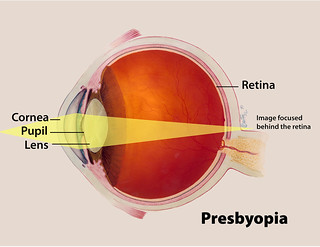 In the case of presbyopia, the image focuses behind the retinal wall, making images appear blurry.