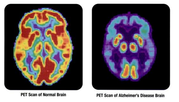 The image shows a typical pet scan and one in a patient with Alzheimers Disease.