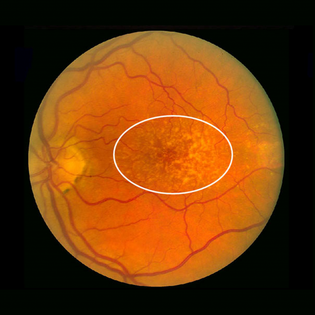 Macular Degeneration Introduction to Sensation and Perception