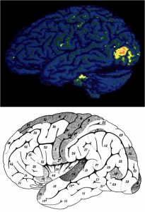 Figure 99.9. The top image is a functional magnetic resonance imaging (fMRI) scan of the human brain that shows regions of increased neural activity that could be associated with the Magnocellular and Parvocellular pathways used in the processing of visual information. The figure at the bottom shows a cerebral cortex diagram with labeled Brodmann areas, which represent areas that might be implicated in these routes of visual processing. The relevance of the Magnocellular route is demonstrated by disorders such as "motion blindness," in which impairment of this pathway impairs one's ability to perceive motion, making daily tasks involving dynamic visual processing more difficult. Disruptions in the Parvocellular pathway, on the other hand, can make it more difficult to recognize colors and fine details, which are important for activities like reading and facial recognition. Different disorders show the complex nature of visual processing in the brain by highlighting the specific roles of different pathways in visual perception and the effects of their disturbance on daily living.