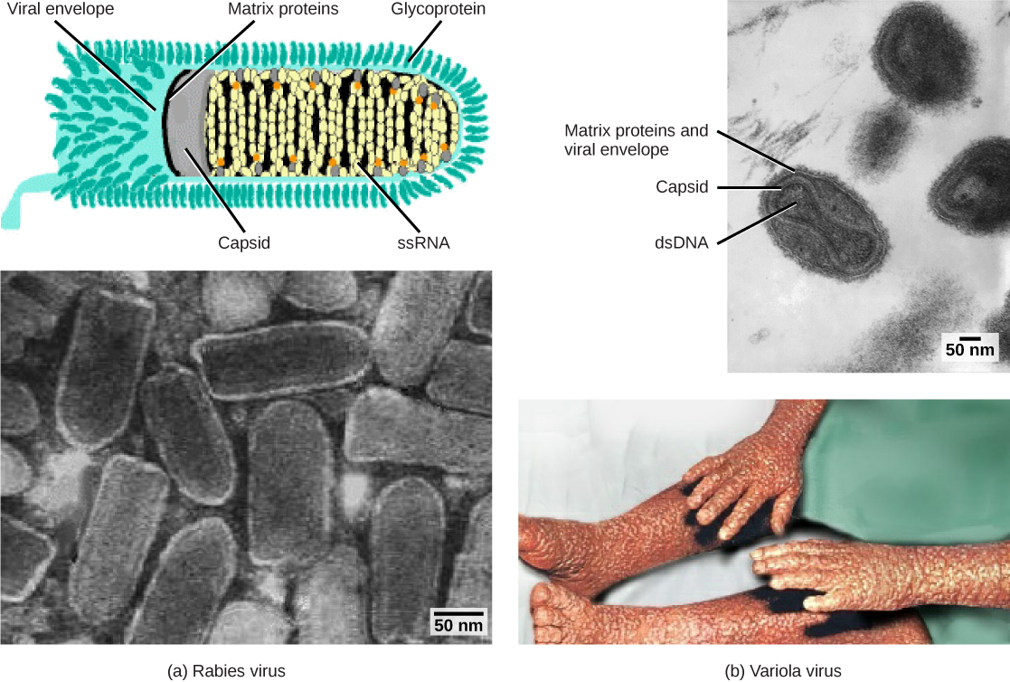 Part a is an illustration of the rabies virus, which is bullet shaped. R N A is coiled inside a capsid, which is encased in a matrix protein lined viral envelope studded with glycoproteins. Part a below is a micrograph of a cluster of bullet shaped rabies viruses. Part b is a micrograph of variola virus, which has D N A encased in a bow shaped capsid. An oval matrix protein-lined envelope surrounds the capsid. Part b below shows irregular, bumpy lesions on the arms and legs of a person with smallpox.