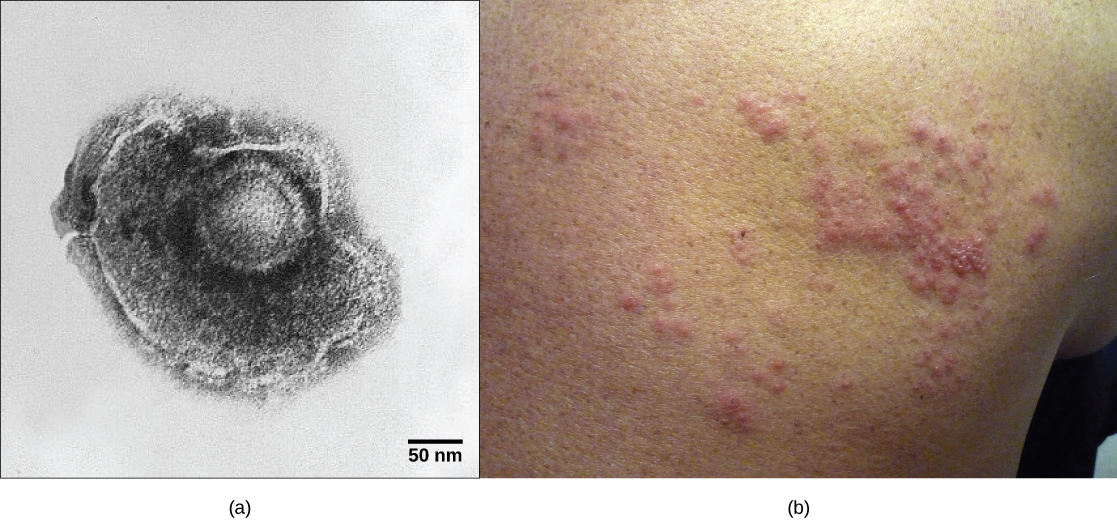 Part a shows a micrograph of the varicella zoster virus, which has an icosahedral capsid surrounded by an irregularly shaped envelope. Part b shows a red, bumpy shingles rash on a person's face.
