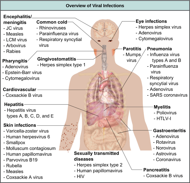 The illustration shows an overview of human viral diseases. Viruses that cause encephalitis or meningitis, or inflammation of the brain and surrounding tissues, include measles, arbovirus, rabies, J C virus, and L C M virus. The common cold is caused by rhinovirus, parainfluenza virus, and respiratory syncytial virus. Eye infections are caused by herpesvirus, adenovirus, and cytomegalovirus. Pharyngitis, or inflammation of the pharynx, is caused by adenovirus, Epstein-Barr virus, and cytomegalovirus. Parotitis, or inflammation of the parotid glands, is caused by mumps virus. Gingivostomatitis, or inflammation of the oral mucosa, is caused by herpes simplex type I virus. Pneumonia is caused by influenza virus types A and B, parainfluenza virus, respiratory syncytial virus, adenovirus, and SARS coronavirus. Cardiovascular problems are caused by coxsackie B virus. Hepatitis is caused by hepatitis virus types A, B, C, D, and E. Myelitis in the spinal cord is caused by poliovirus and H L T V dash 1. Skin infections are caused by varicella-zoster virus, human herpesvirus 6, smallpox, molluscum contagiosum, human papillomavirus, parvovirus B 19, rubella, measles, and coxsackie A virus. Gastroenteritis, or digestive disease, is caused by adenovirus, rotavirus, norovirus, astrovirus, and coronavirus. Sexually transmitted diseases are caused by herpes simplex type 2, human papillomavirus, and H I V. Pancreatitis B is caused by coxsackie B virus.