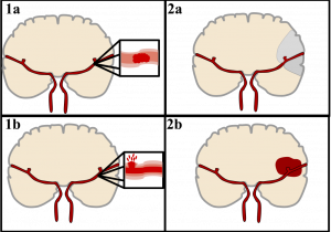 The cartoon is separated into two rows. The top depicts a stroke occurring due to a blood clot. On the left, a blood vessel in the brain is shown. They then zoom in on the vein to show a blood clot. On the right, the area affected by the blood clot is indicated by darkening about 1/6 of the brain. On the bottom the same outline is used to depict a stroke caused by a burst blood vessel. On the left, the zoomed in image shows a blood vessel where there is a tear in the top side. On the right, the area affected is depicted with a red blob indicating where the blood has leaked into the brain.