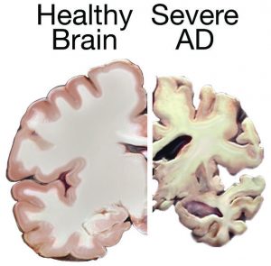 The image depicts a healthy brain on the left. This brain is plump and voluminous. On the right, the image depicts the brain of someone with severe Alzheimer's Disease. This brain is significantly smaller and shriveled. If the left side was a grape, the right side would be a raisin.